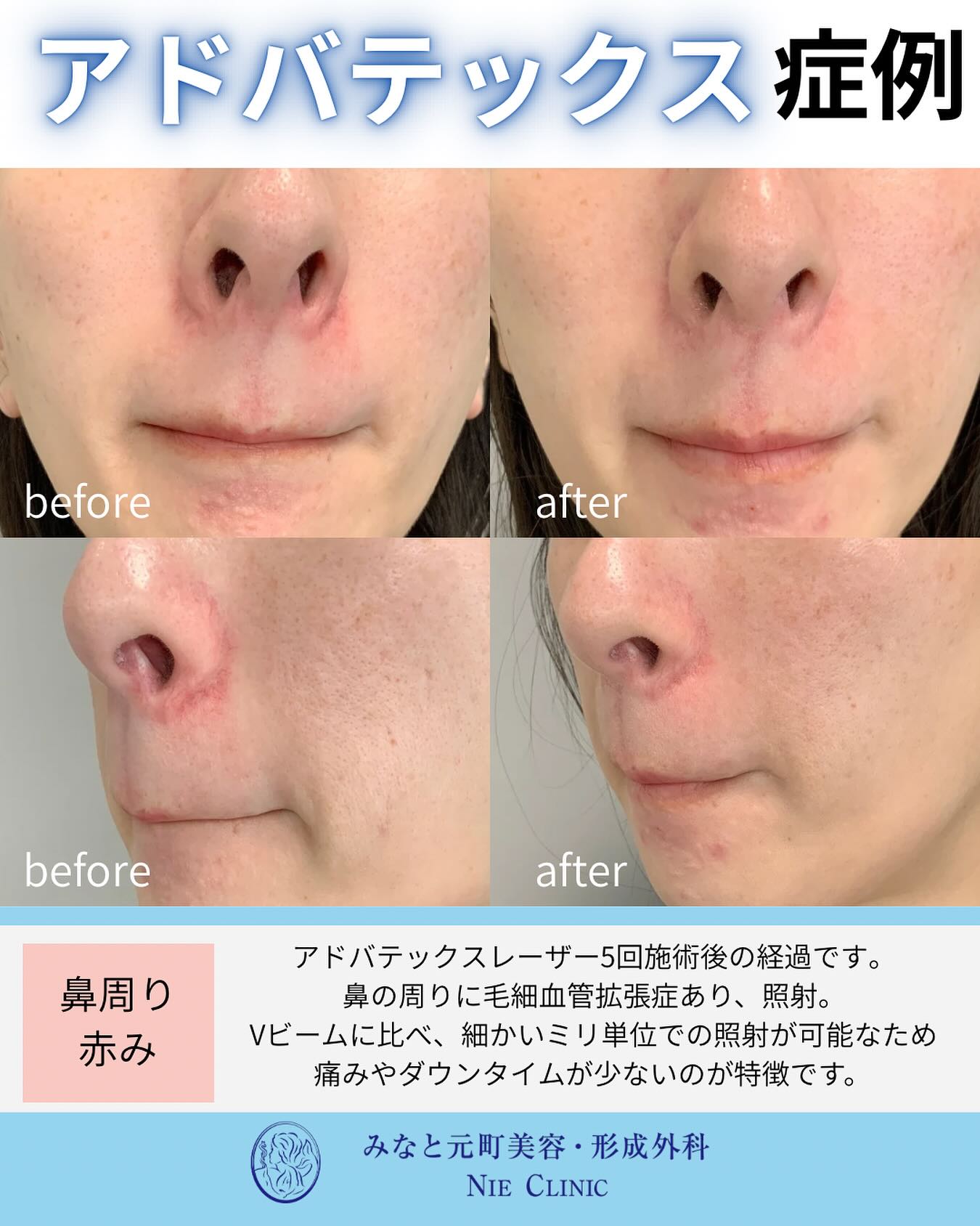 当院で大人気のアドバテックスレーザーの症例のご紹介です🫧