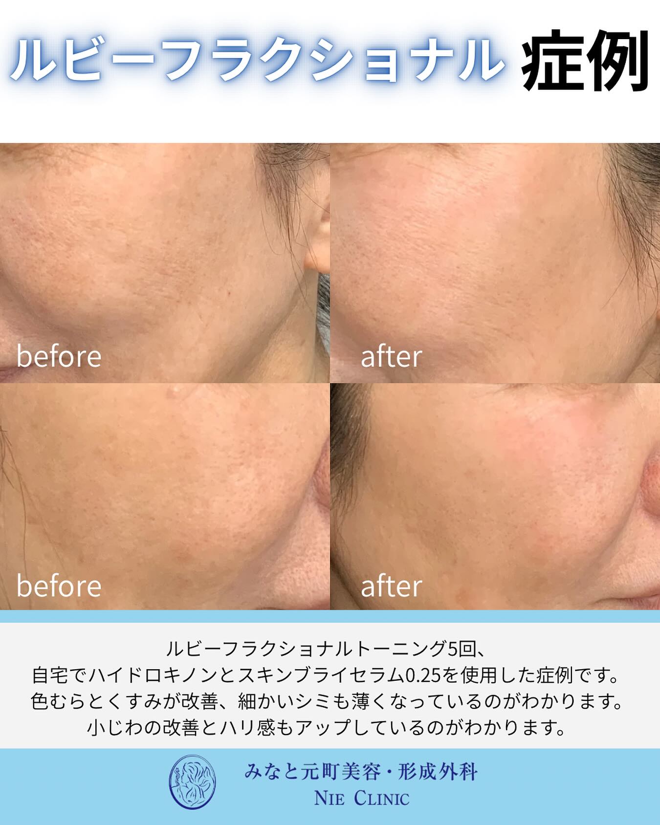 当院で大人気のルビーフラクショナルの症例のご紹介です🫧