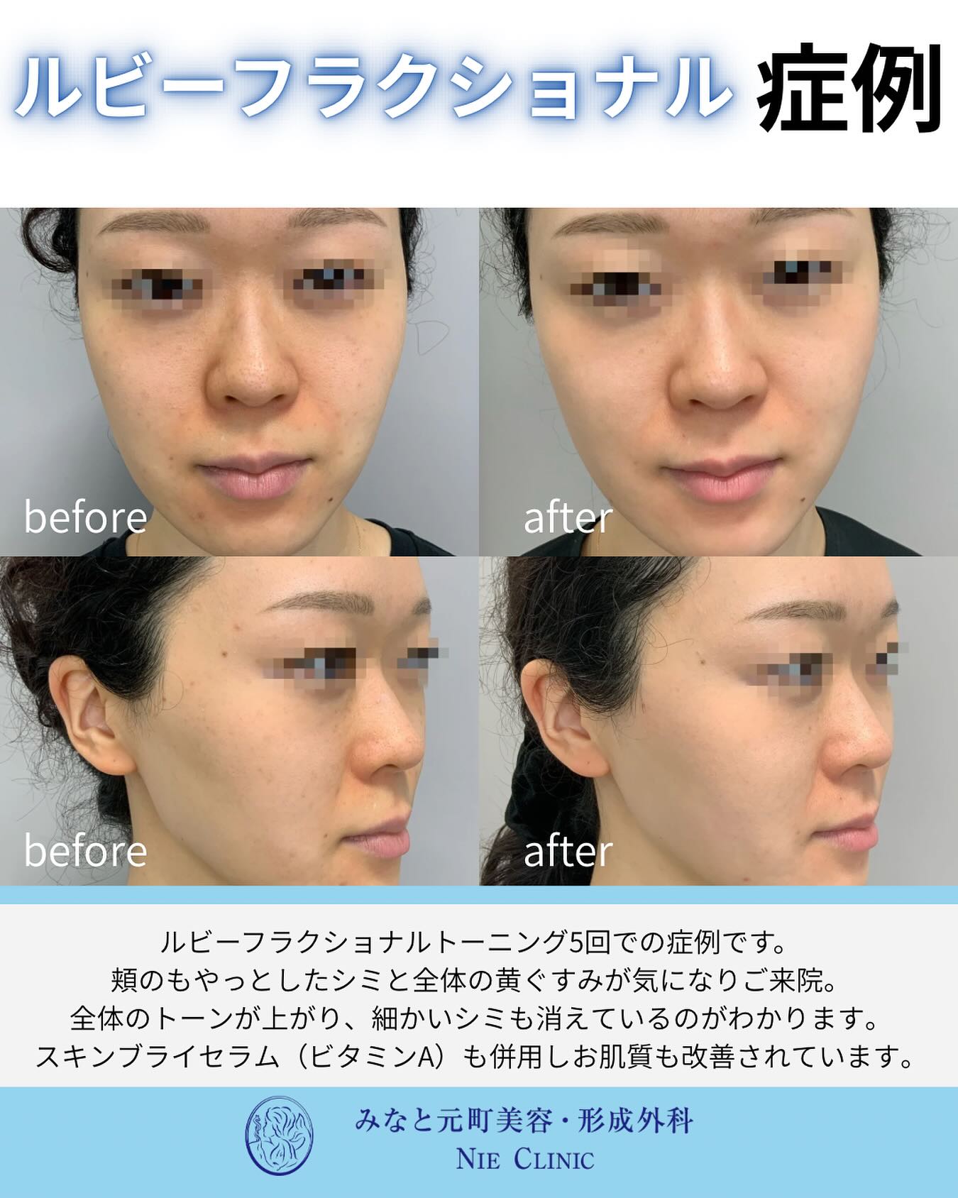 当院で大人気のルビーフラクショナルの症例のご紹介です🫧