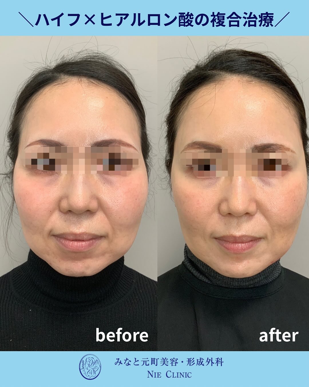 ハイフとヒアルロン酸の複合治療症例