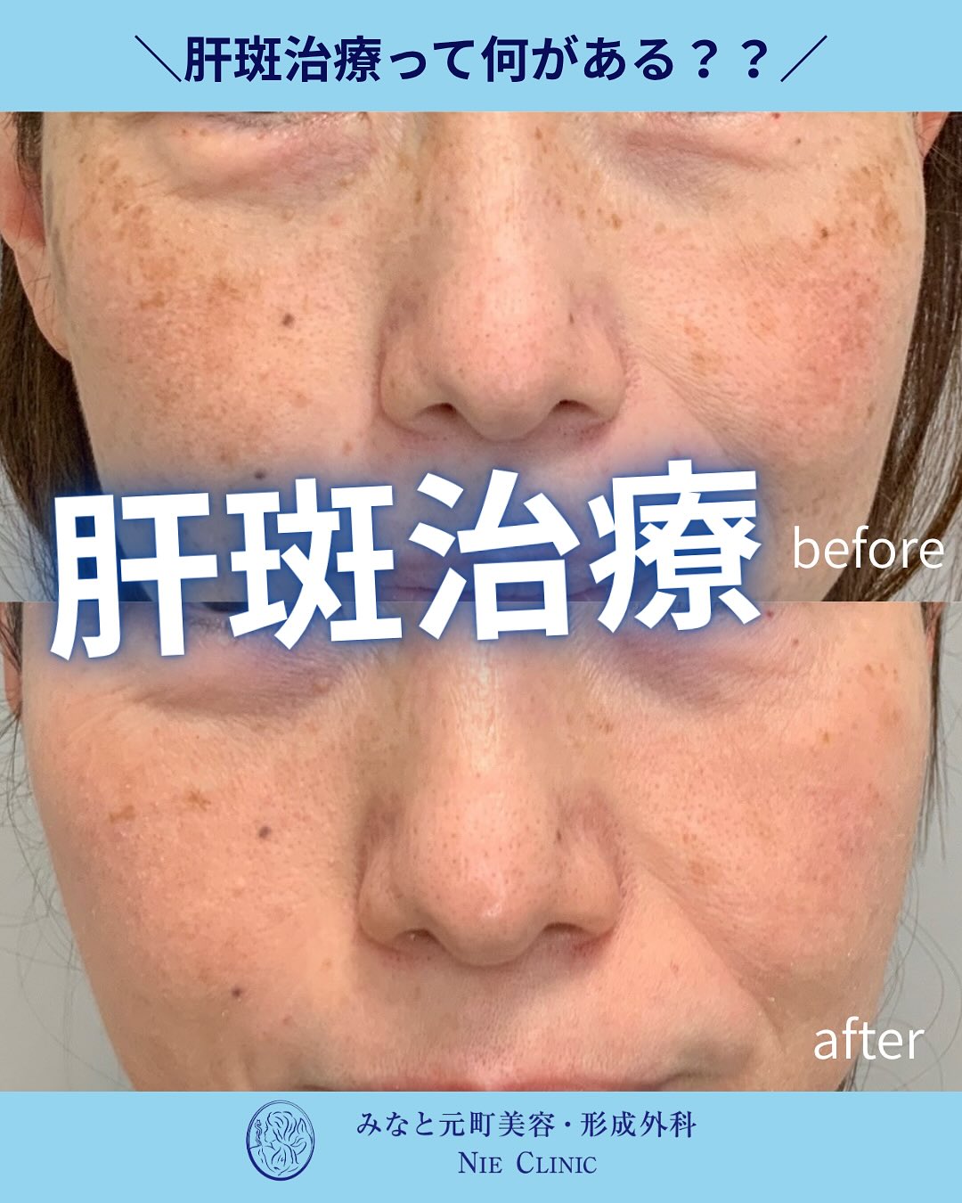 肝斑の特徴と治療紹介