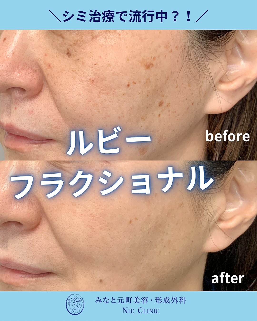 ルビーフラクショナルのご紹介