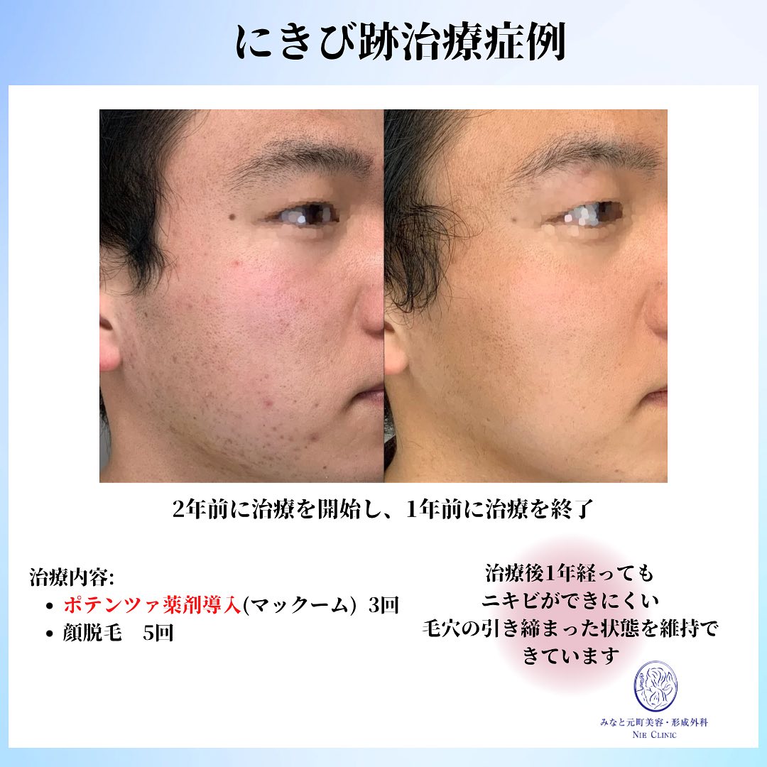 ニキビ肌にポテンツァ&脱毛治療