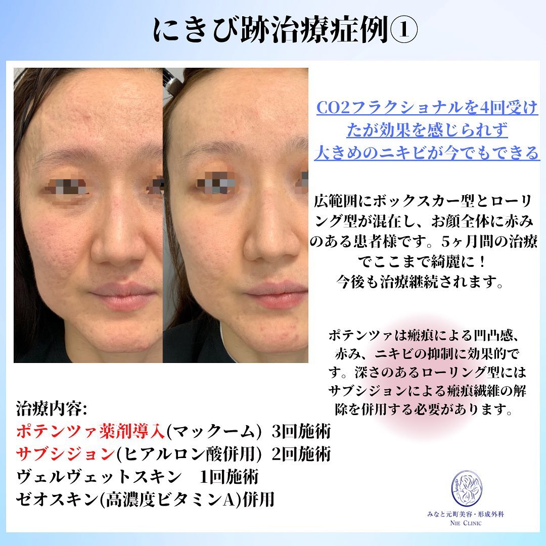 にきび跡の治療症例