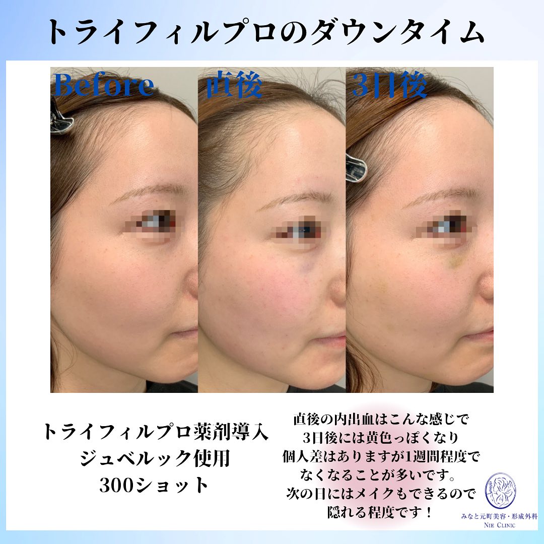 トライフィルプロ薬剤導入のダウンタイム