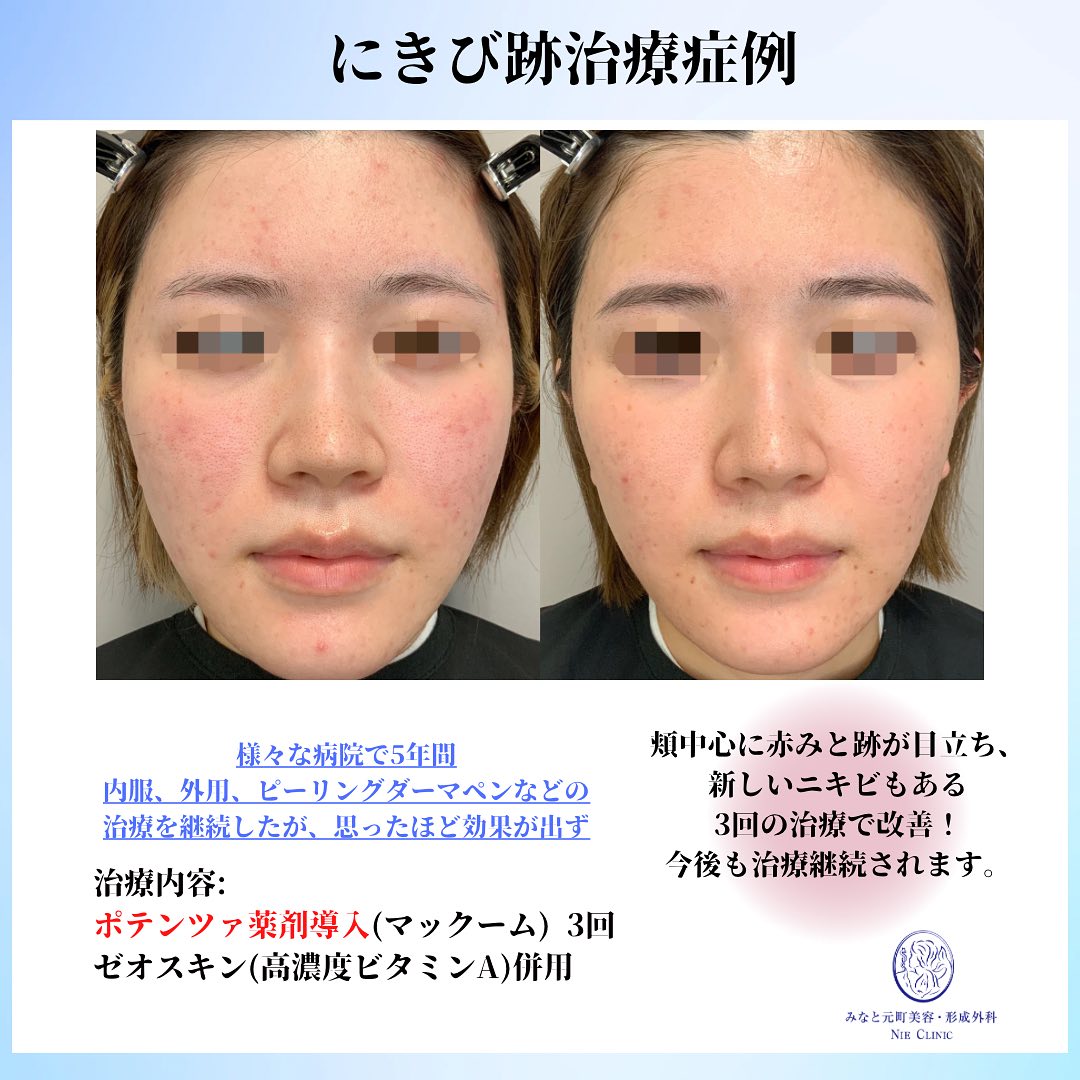 にきび跡と赤みの治療に関する美容コラム