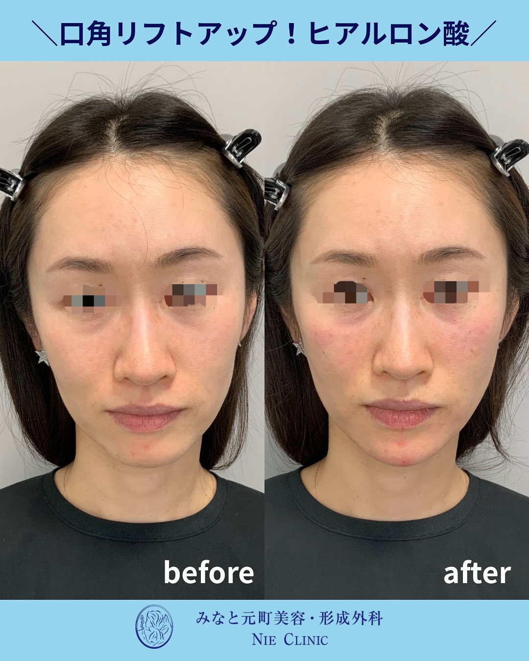 口元のたるみに対するヒアルロン酸症例
