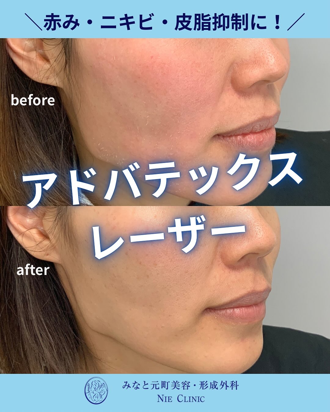 アドバテックスレーザー治療のご紹介