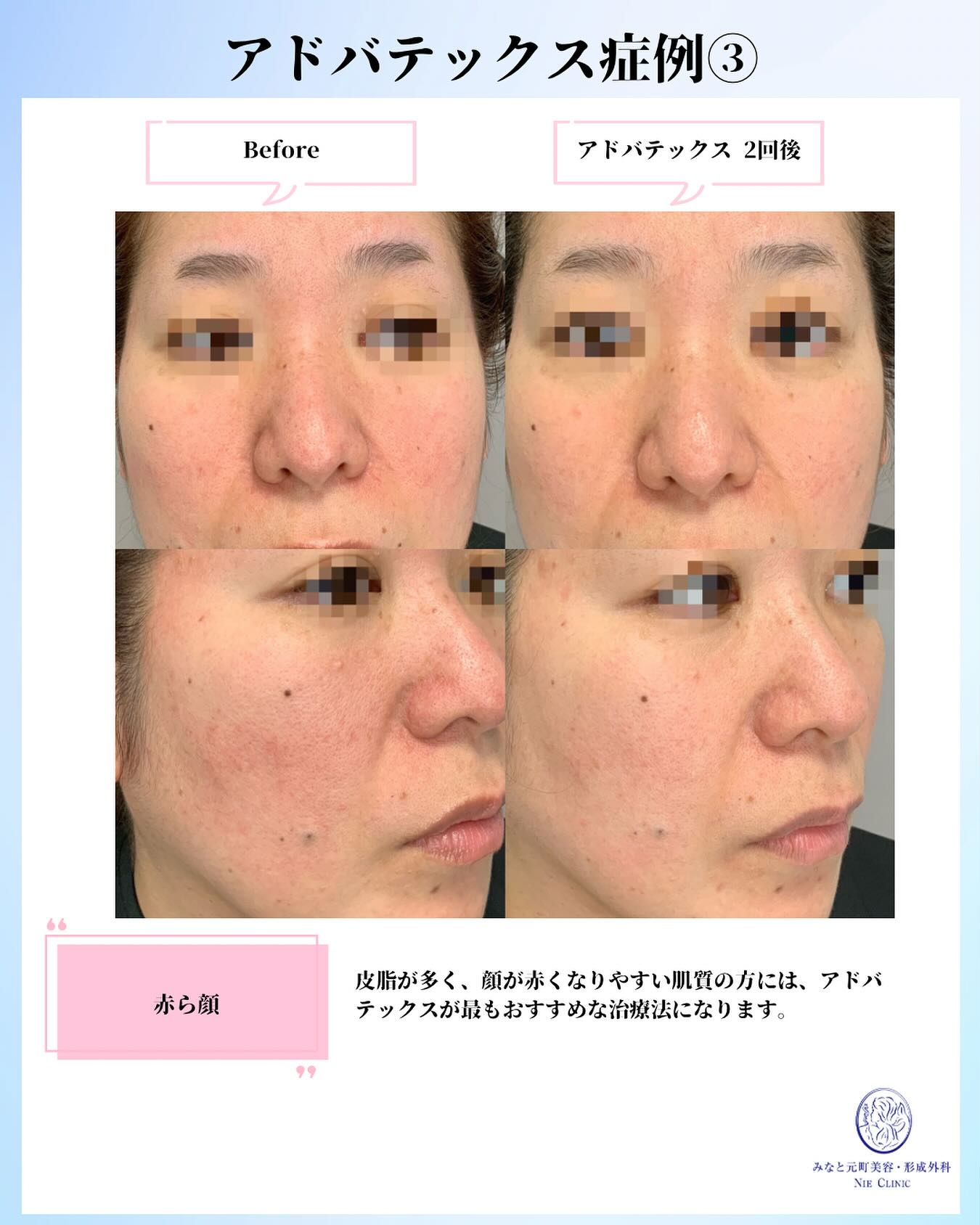 アドバテックス症例の赤みと皮脂の変化を示す比較画像