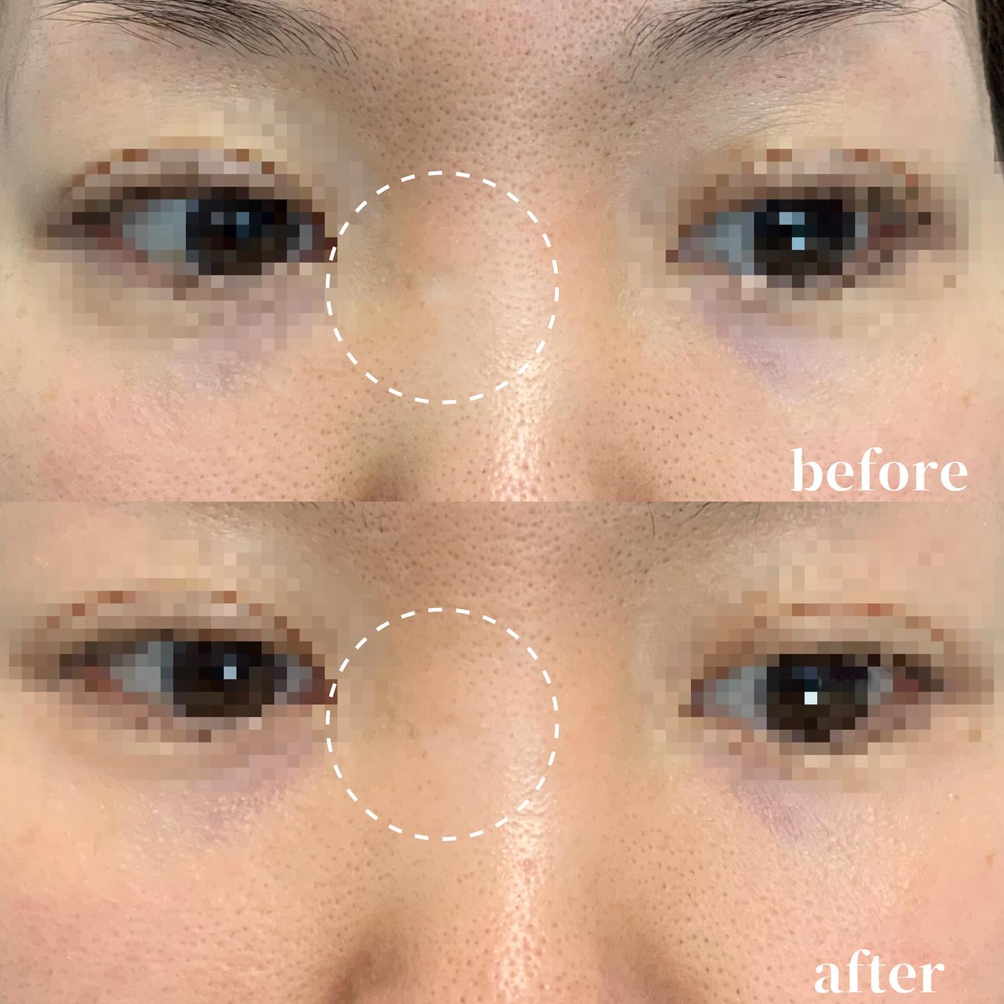 トライフィルプロ瘢痕モードの症例