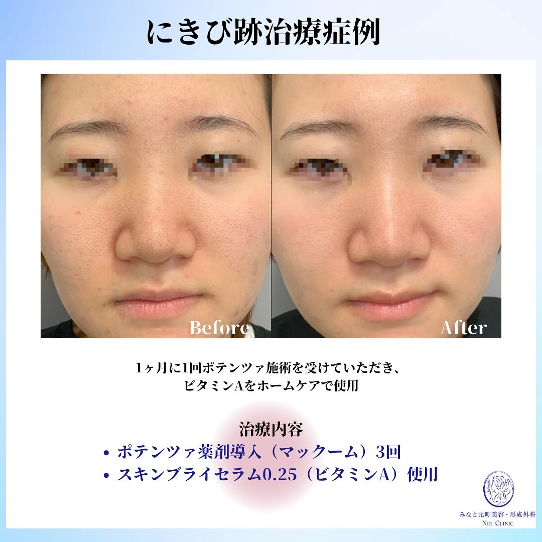 にきび肌のポテンツァ治療