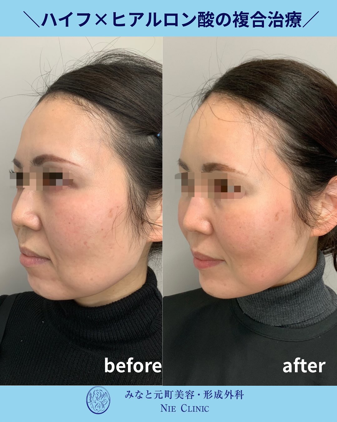ハイフとヒアルロン酸の複合治療症例