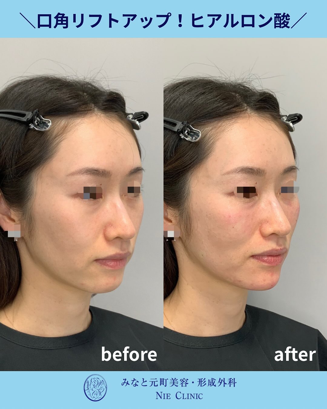 口元のたるみに対するヒアルロン酸症例