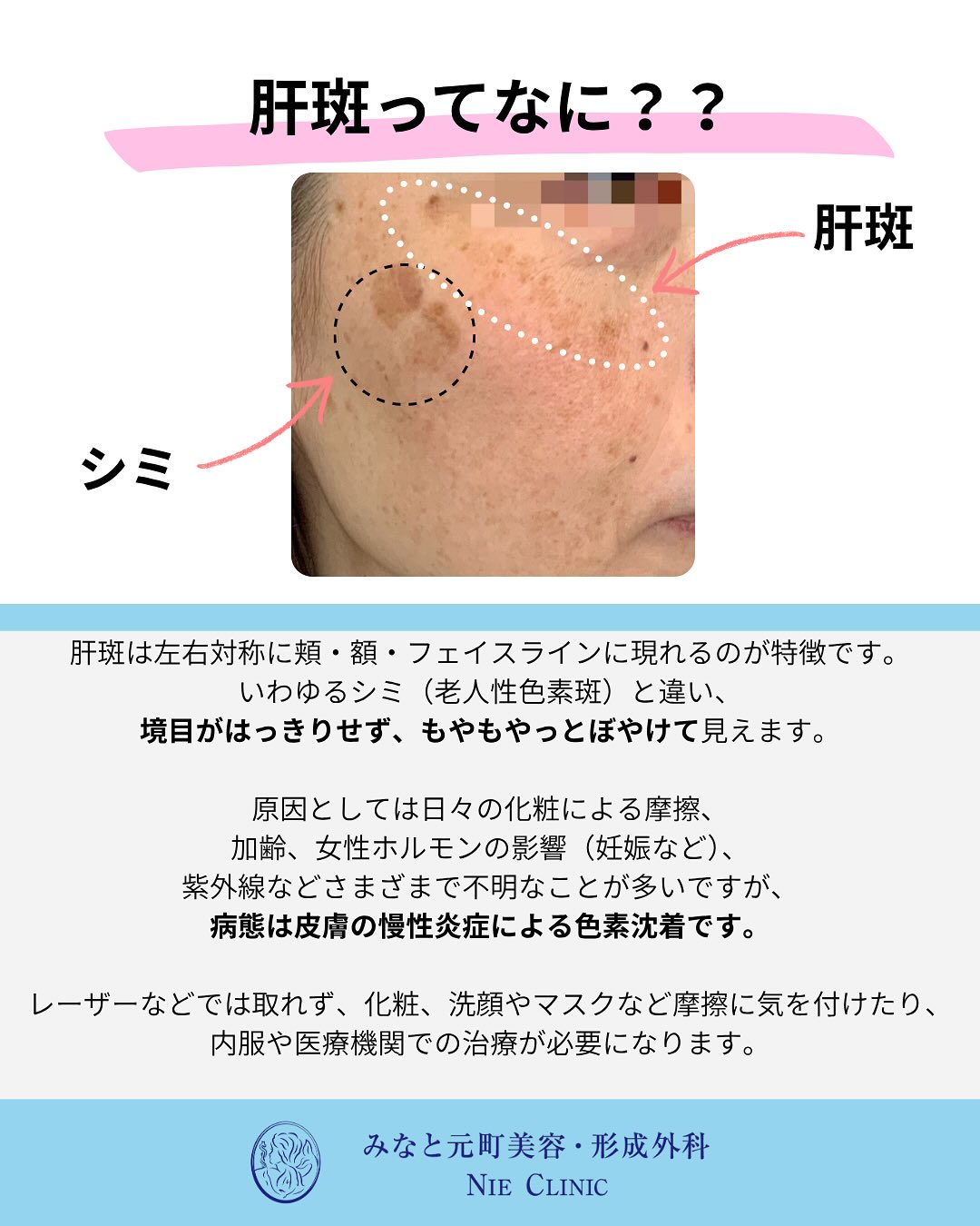 肝斑の特徴と治療紹介