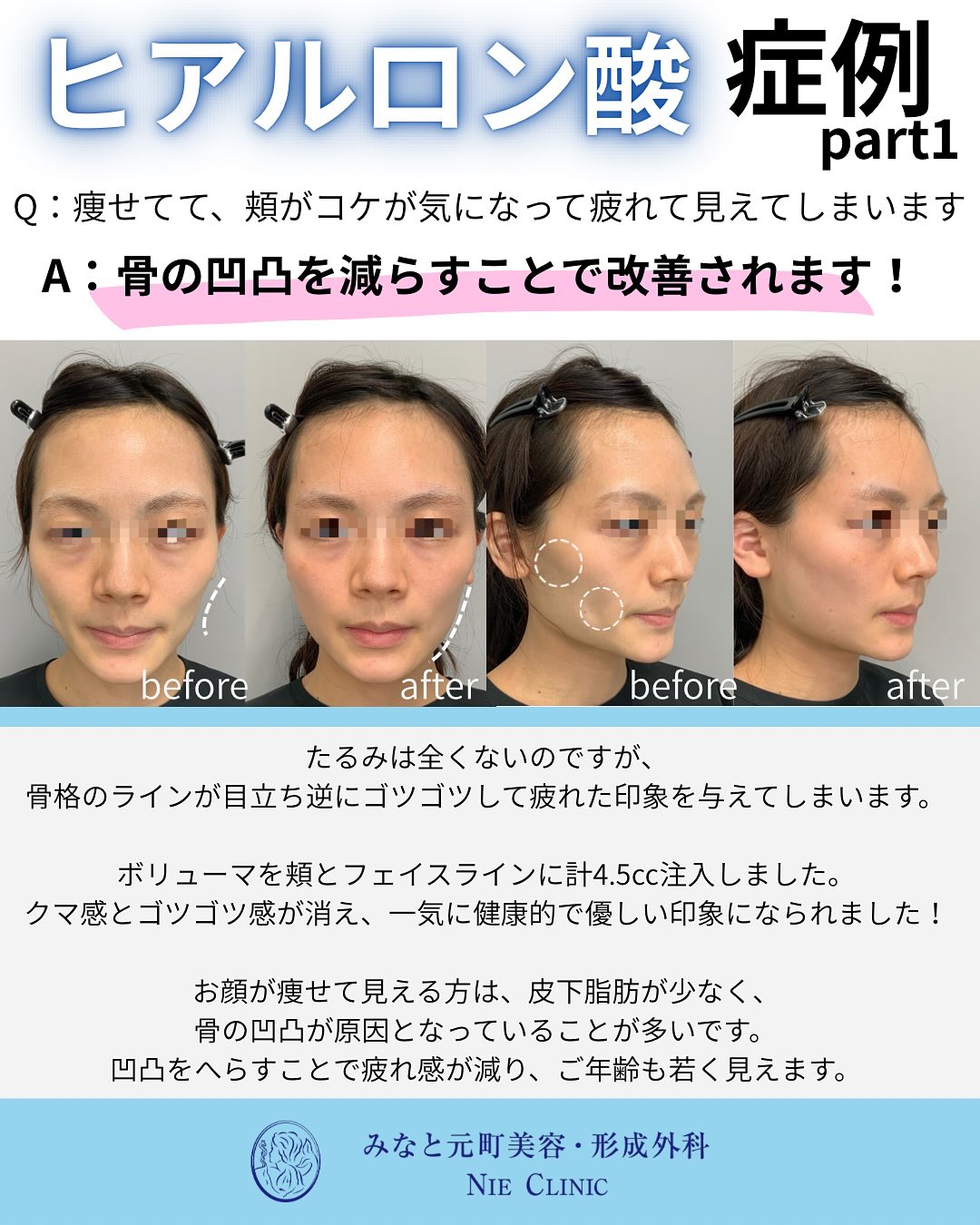 ヒアルロン酸施術のご紹介