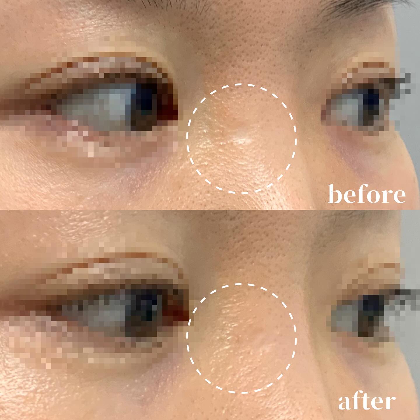 トライフィルプロ瘢痕モードの症例