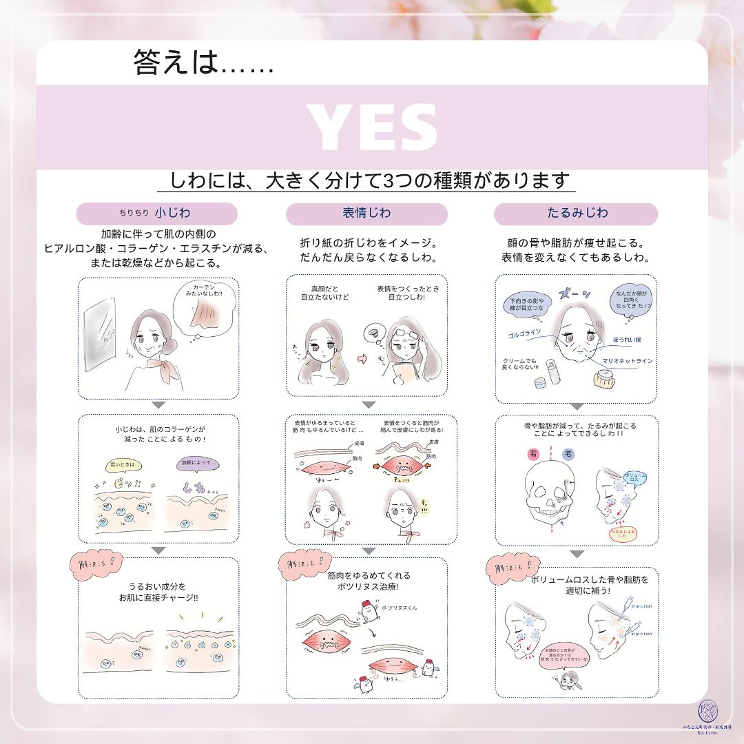 しわの日に合わせて、しわの種類、原因とその対処法