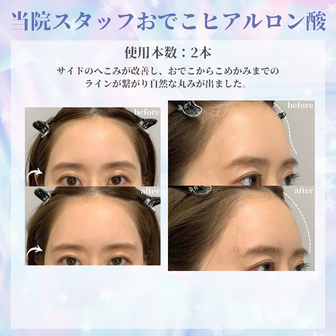 当院スタッフのおでこヒアルロン酸症例をご紹介します🥰