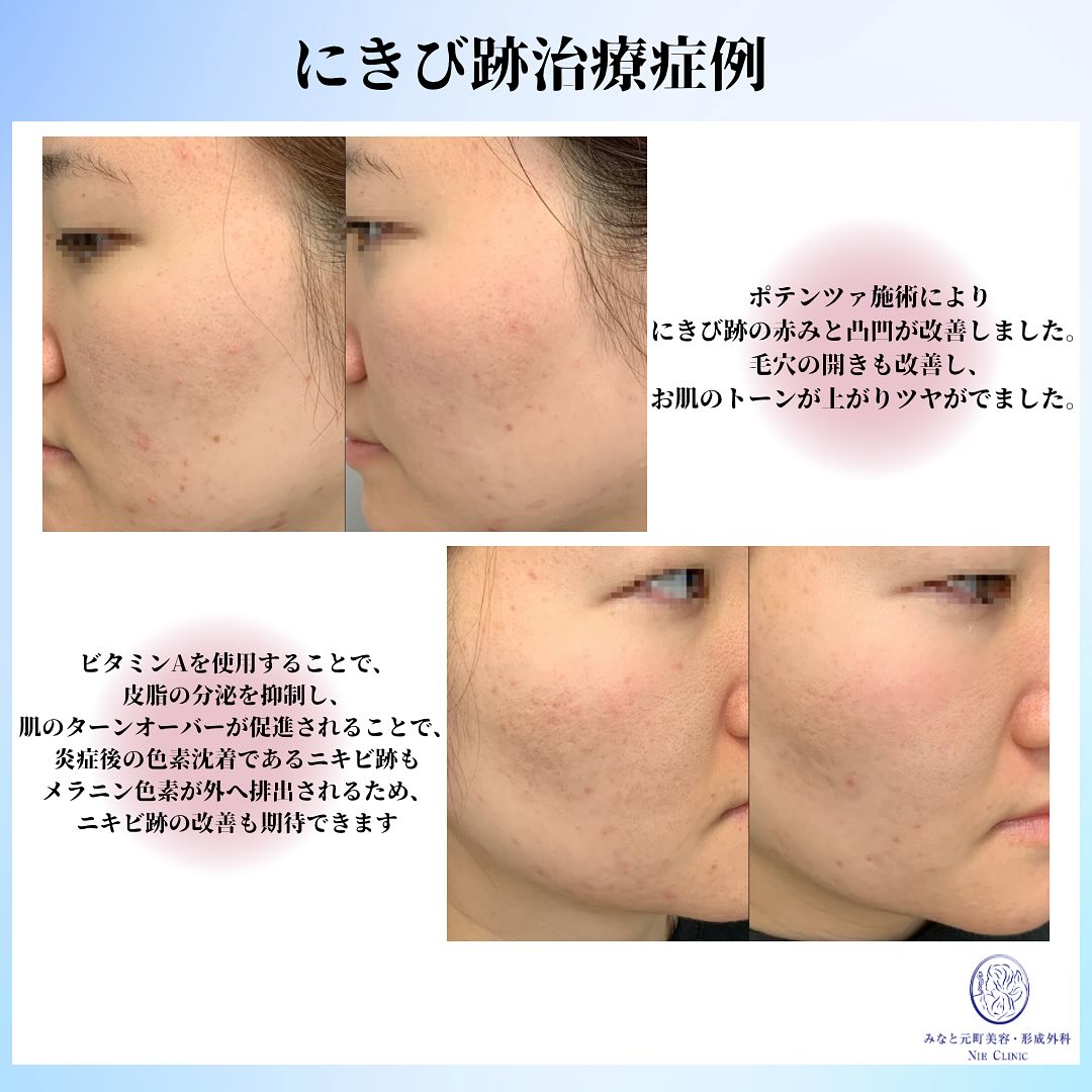 にきび肌のポテンツァ治療