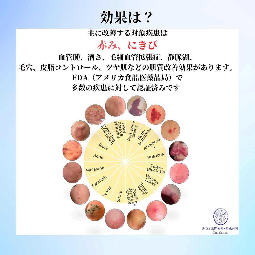 アドバテックスレーザー導入前のお知らせ