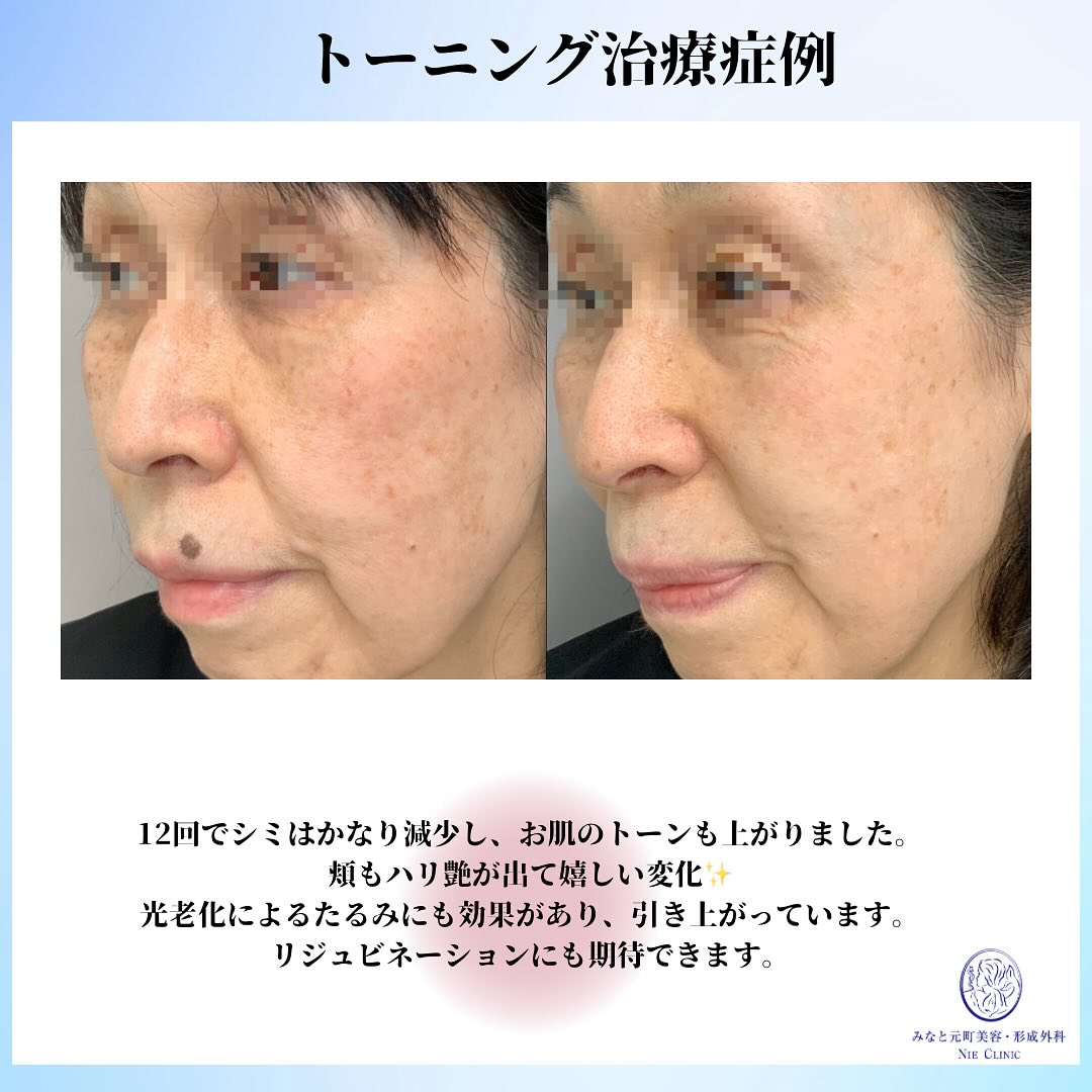 《レーザートーニングの症例のご紹介です✨》