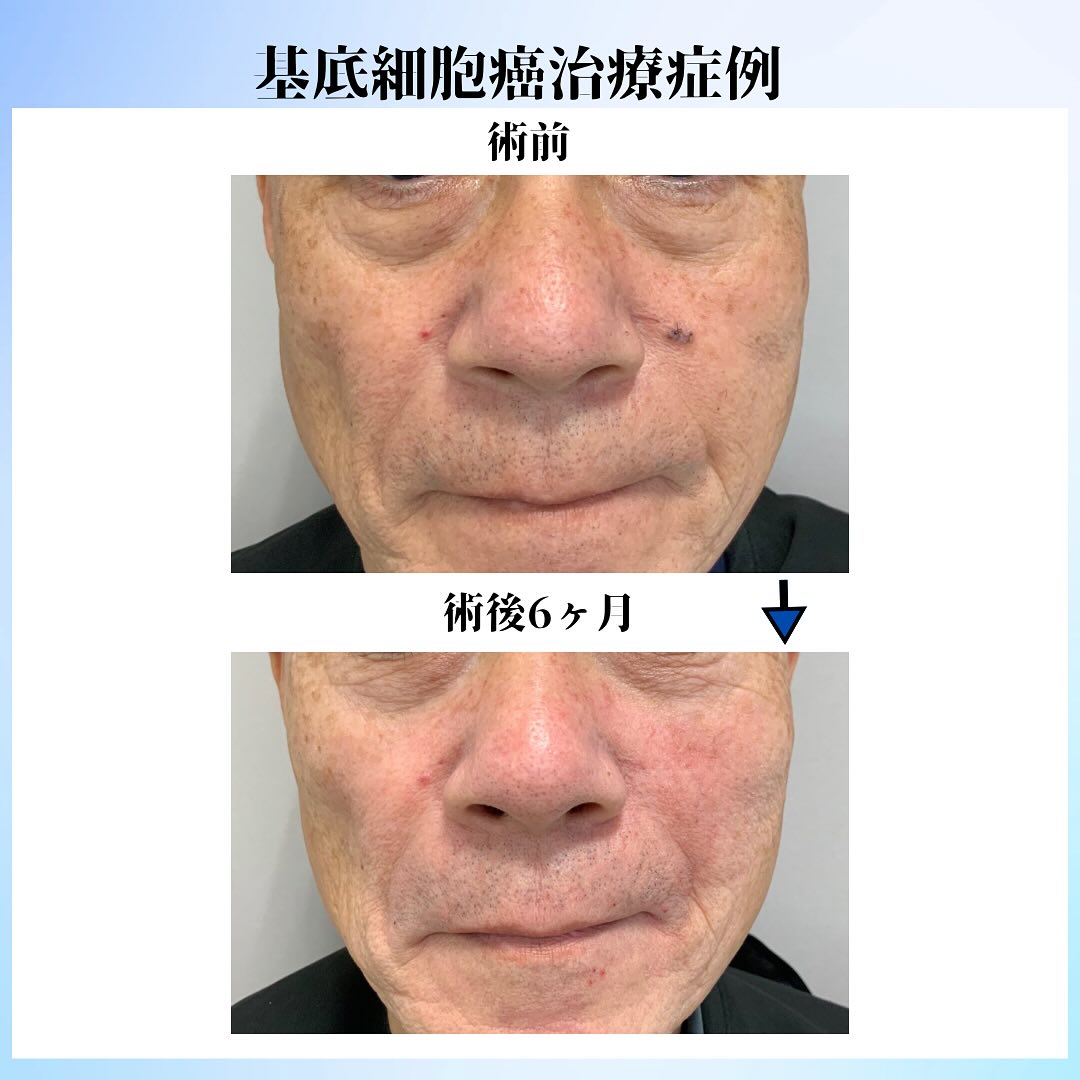 皮膚腫瘍