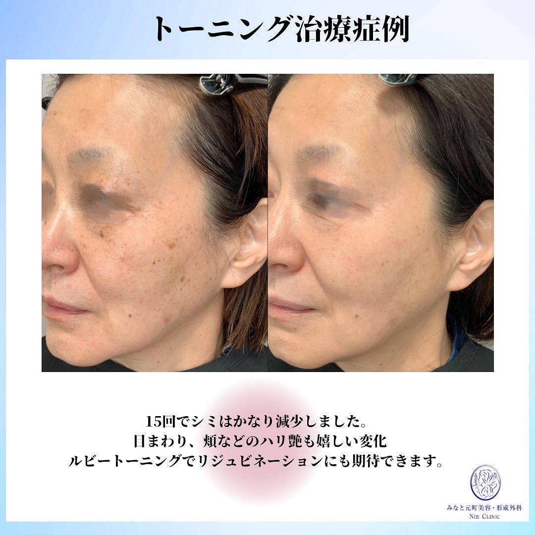《レーザートーニングの症例のご紹介です✨》