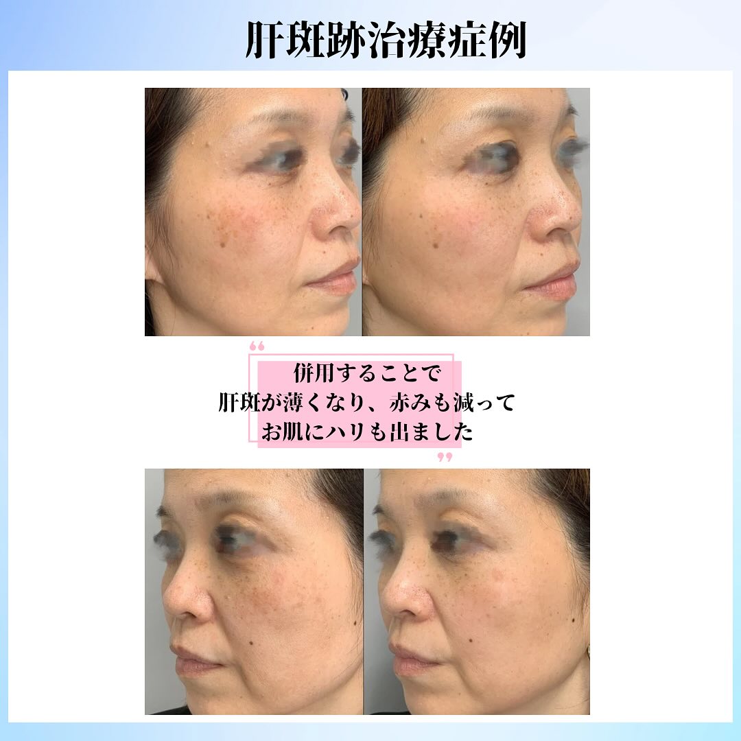 《肝斑治療の症例のご紹介です✨》