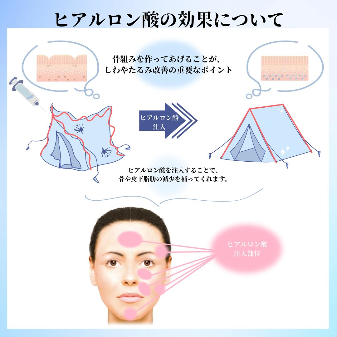 《アンチエイジングの治療にヒアルロン酸は必要なのか》