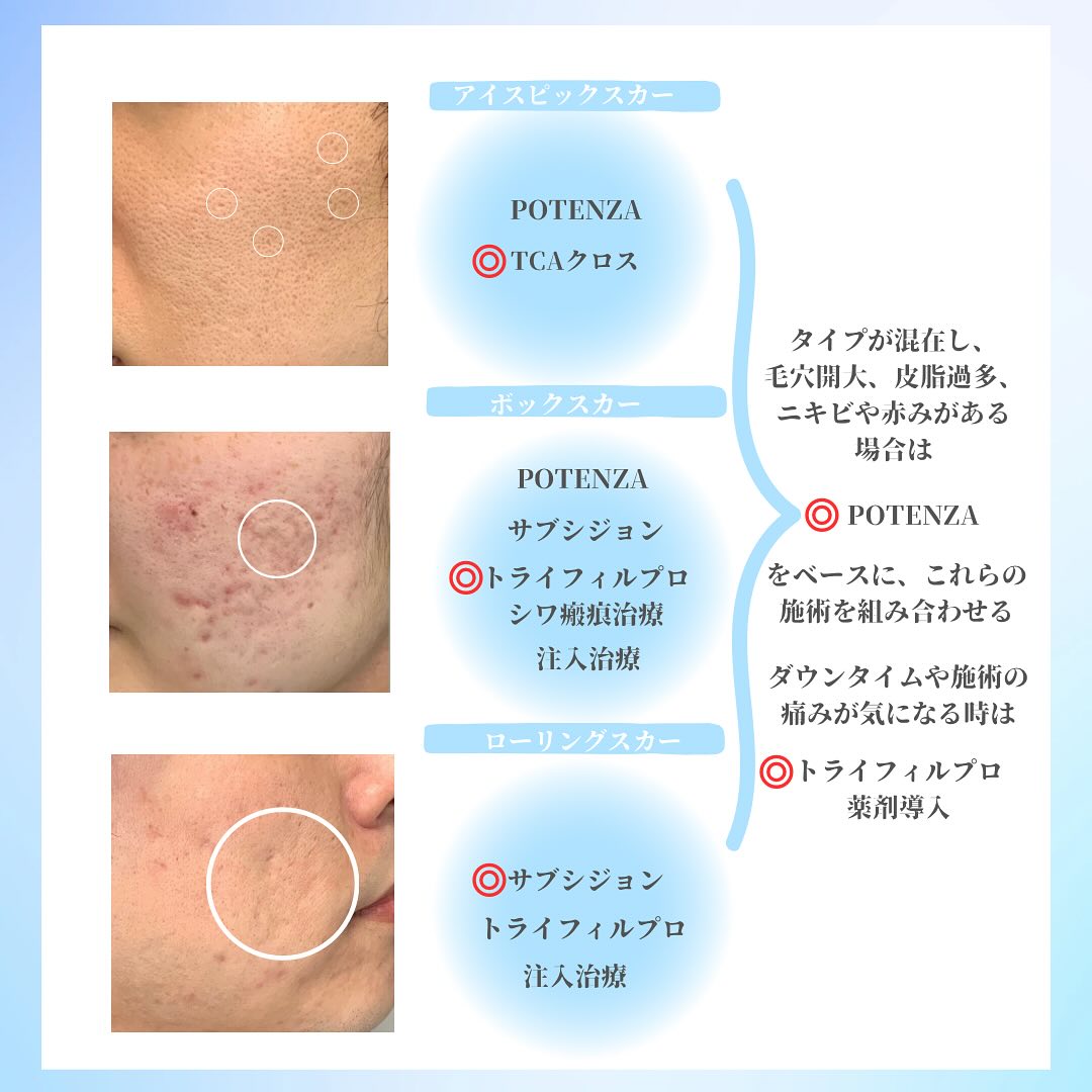 《にきび跡の種類と当院の治療方針》