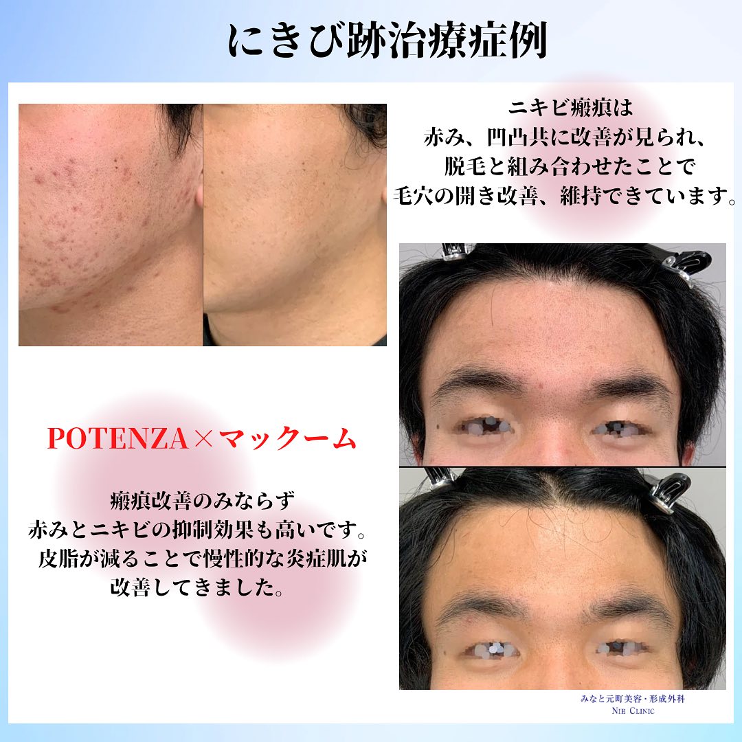 ニキビ肌にポテンツァ&脱毛治療
