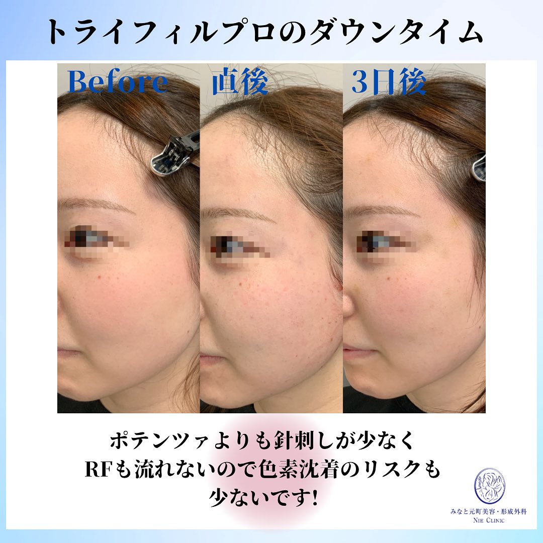 ☝️トライフィルプロ薬剤導入のダウンタイム☝️