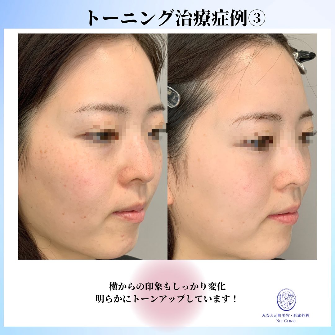 レーザートーニングの症例のご紹介です✨