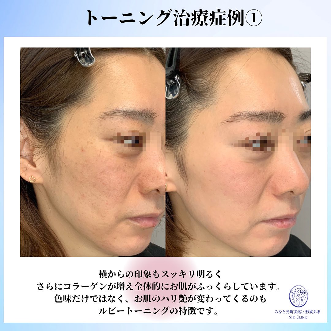 レーザートーニングの症例のご紹介です✨