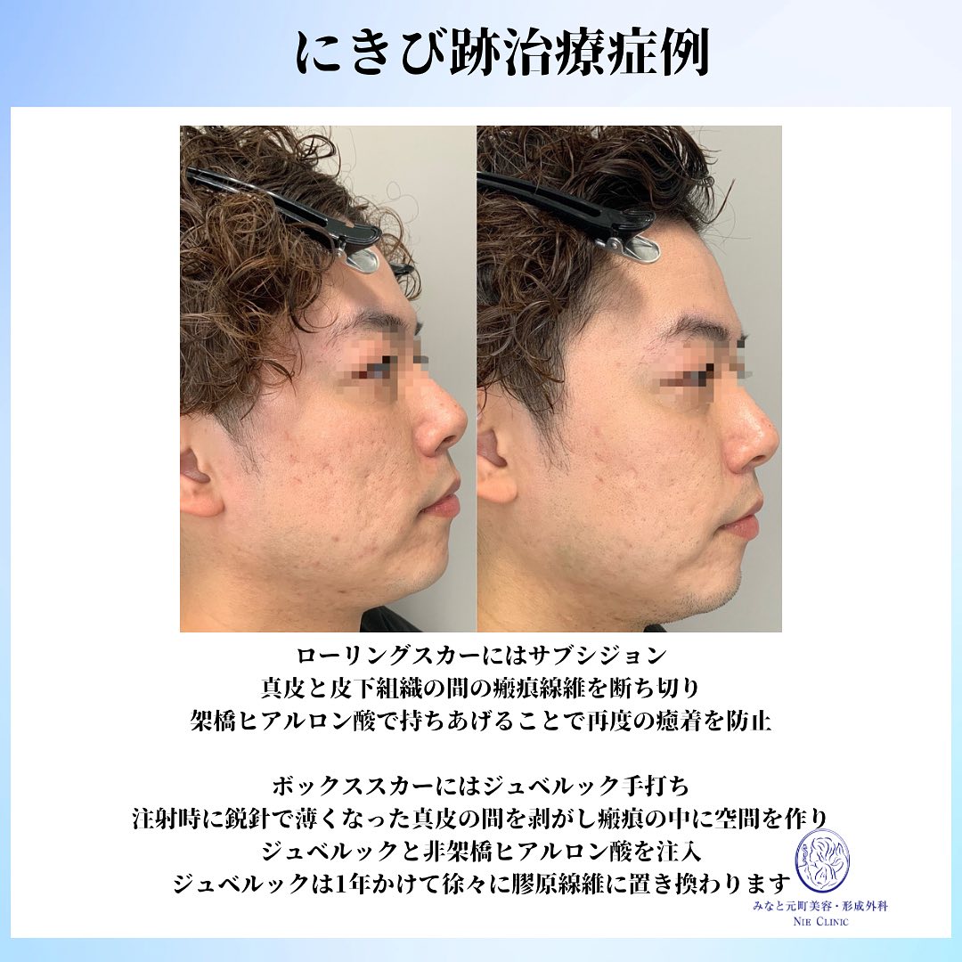 にきび跡と赤みの治療