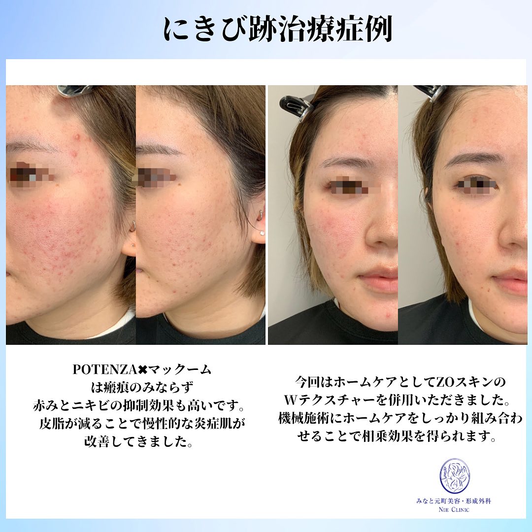 にきび跡と赤みの治療