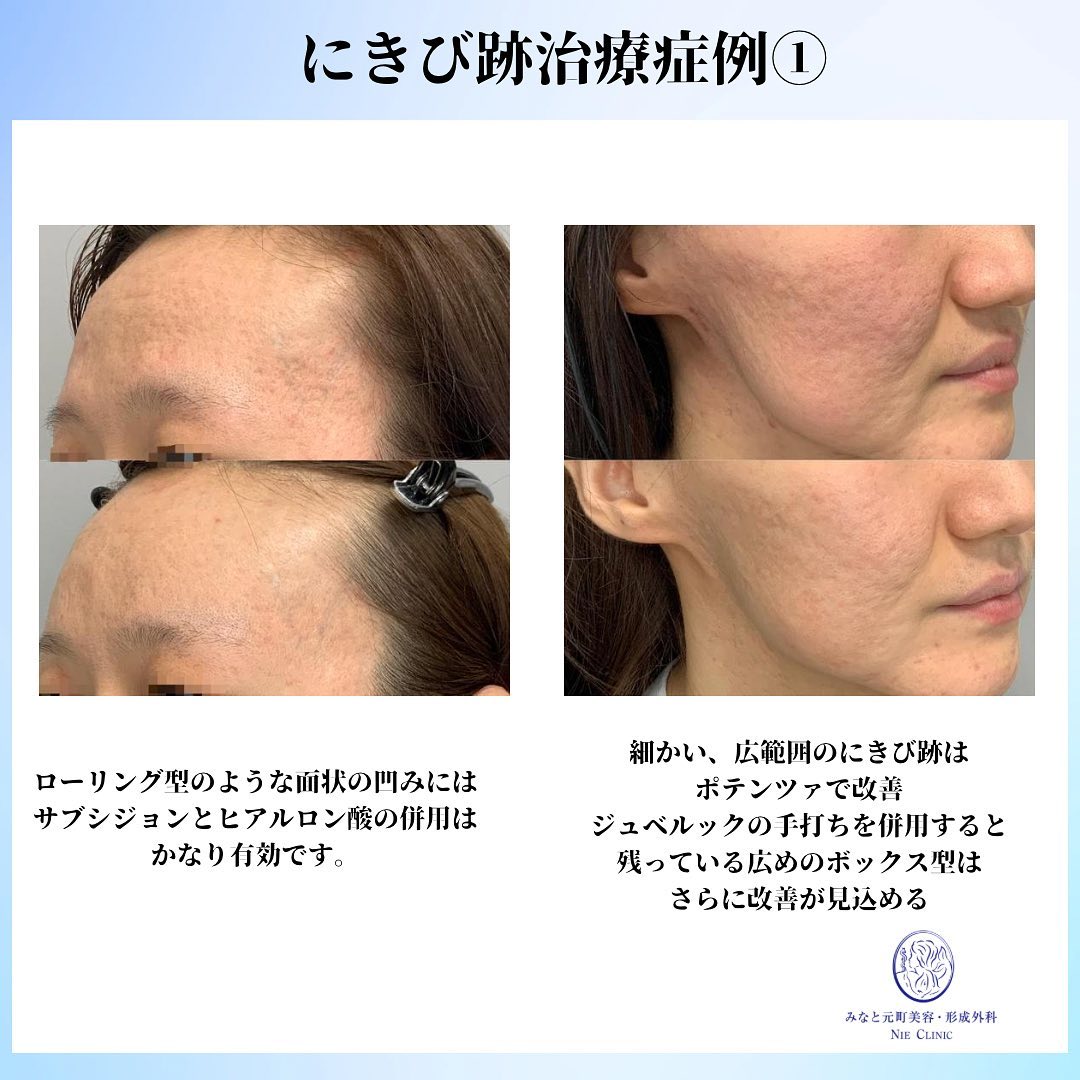 にきび跡の治療症例
