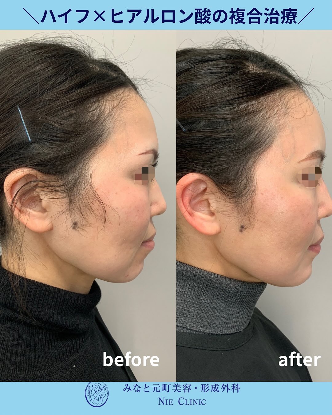 ハイフとヒアルロン酸の複合治療症例