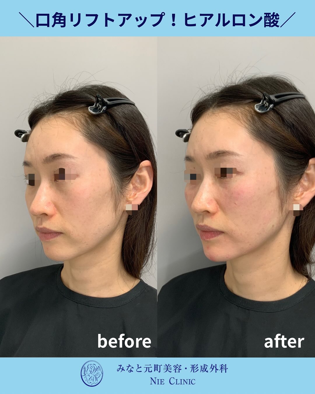 口元のたるみに対するヒアルロン酸症例