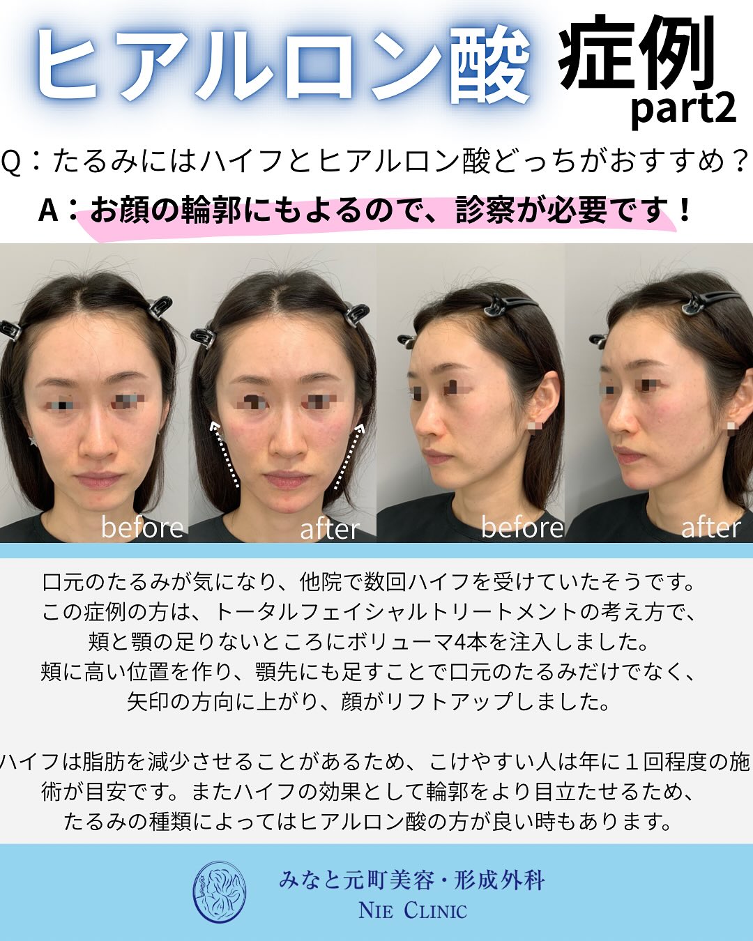 ヒアルロン酸施術のご紹介