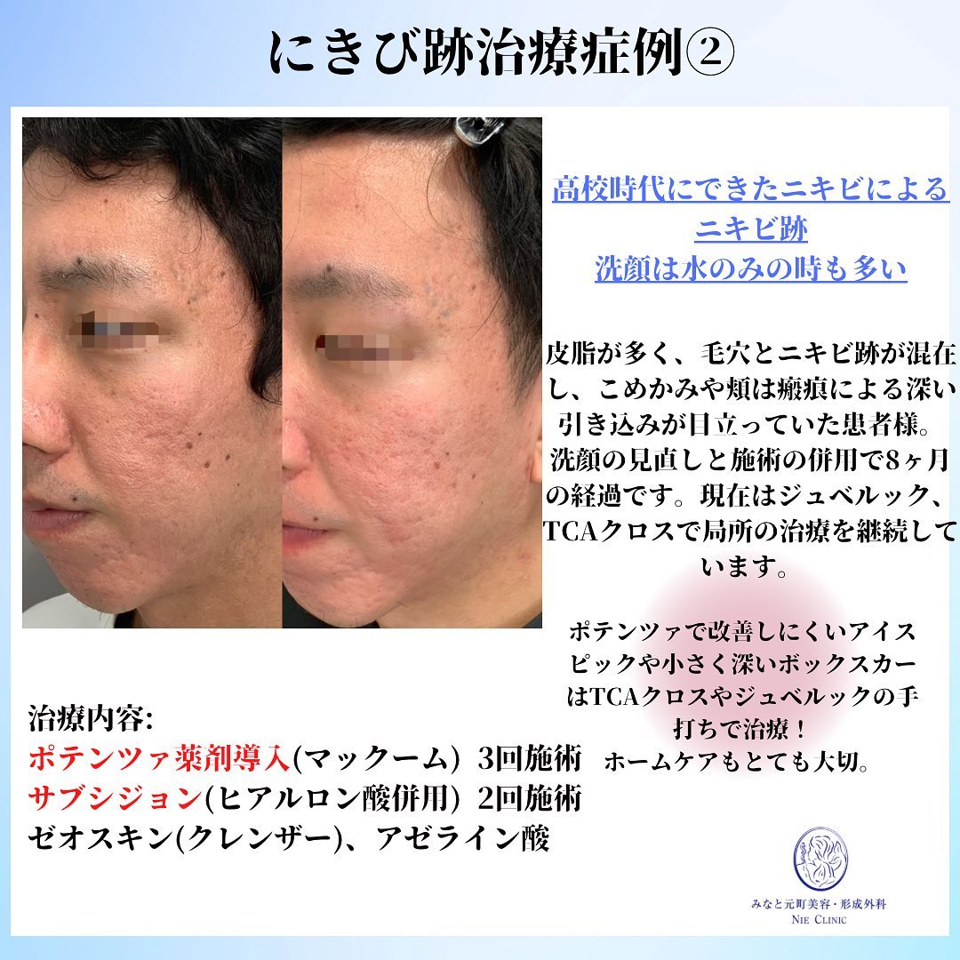 にきび跡の治療症例