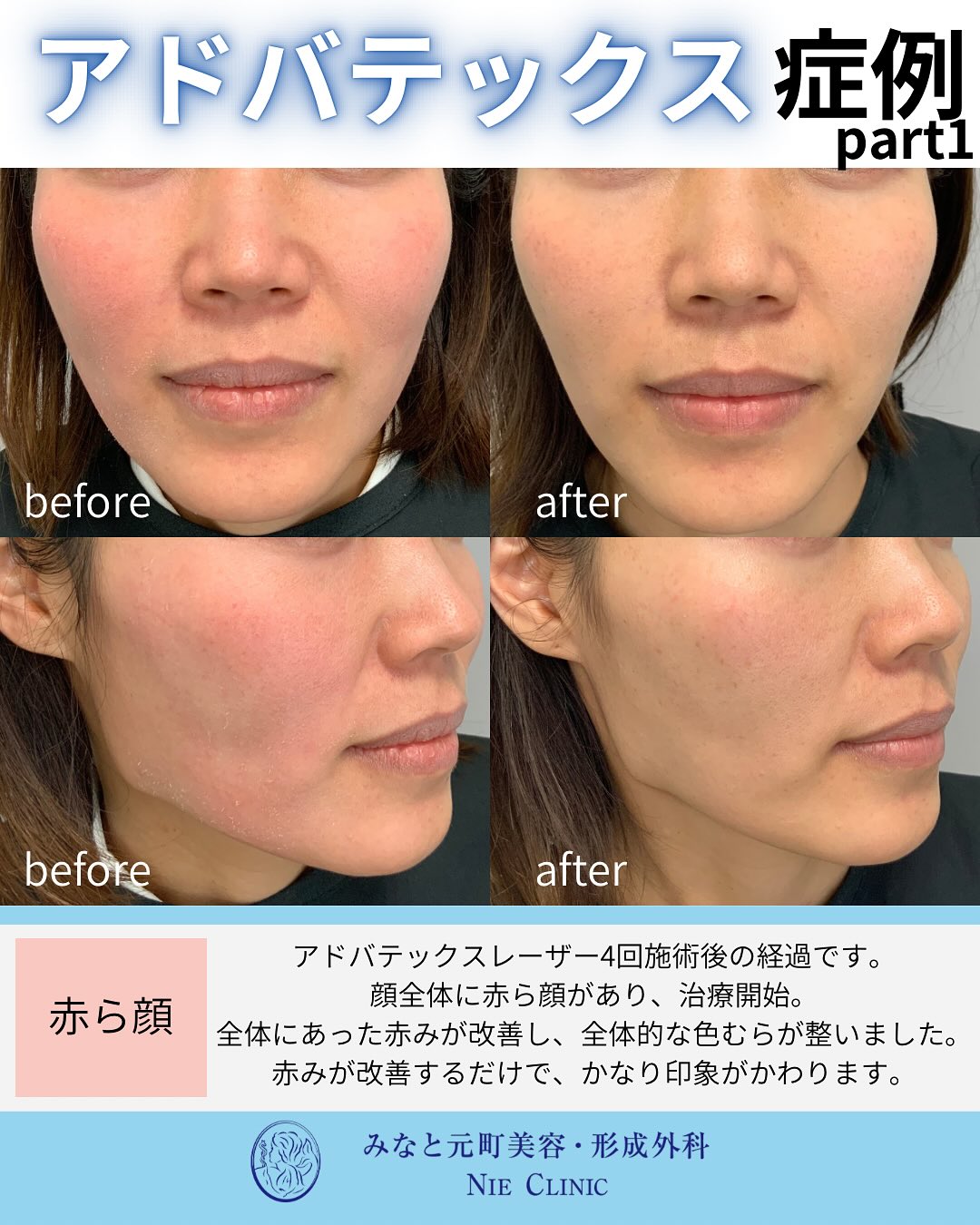 アドバテックスレーザー治療のご紹介