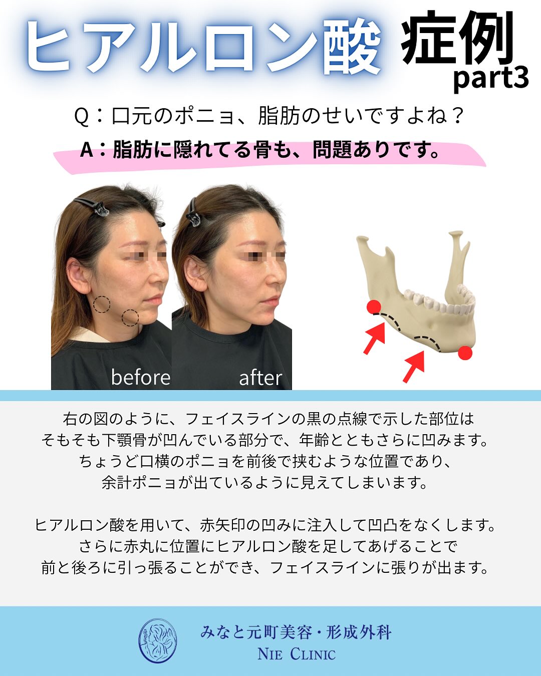 ヒアルロン酸施術のご紹介