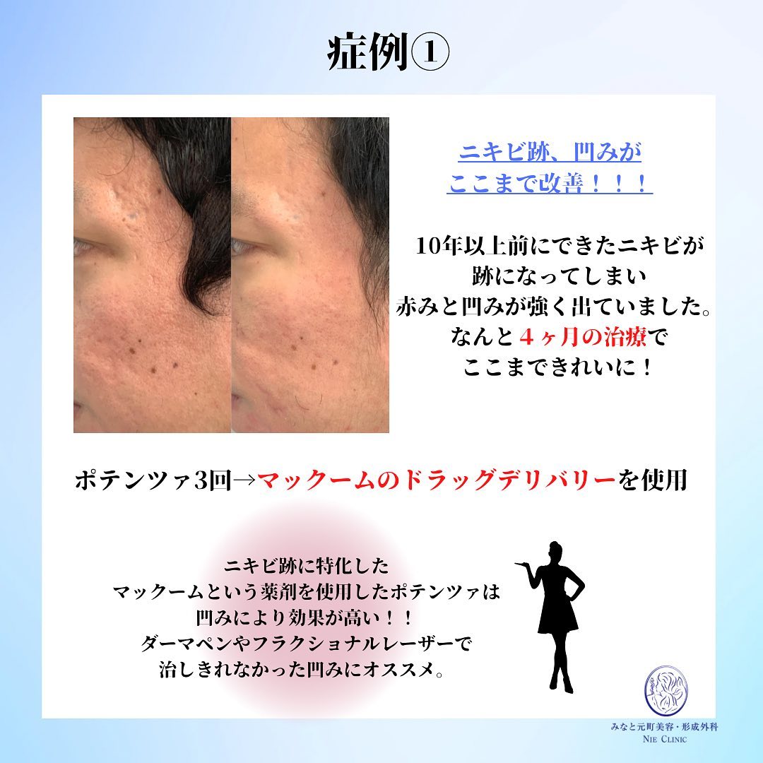 お肌の救世主・ポテンツァ