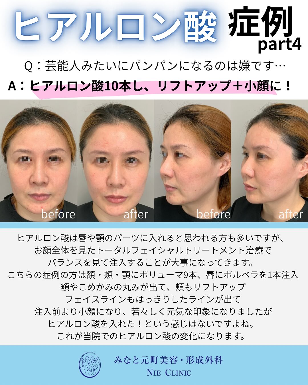 ヒアルロン酸施術のご紹介
