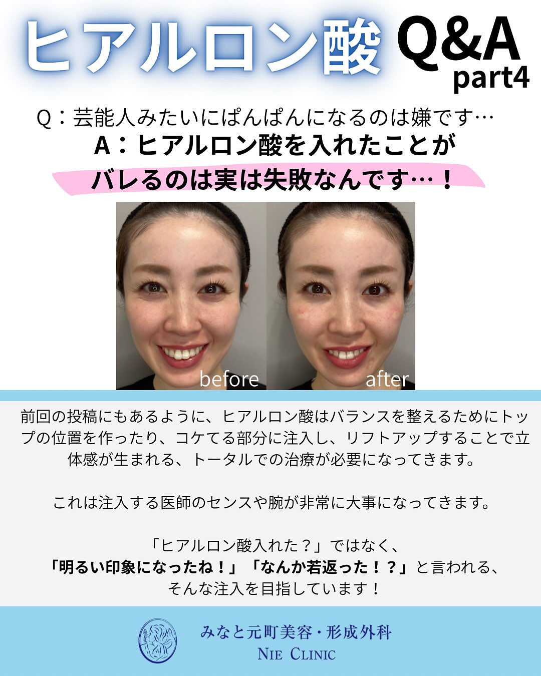 ヒアルロン酸のよくある質問