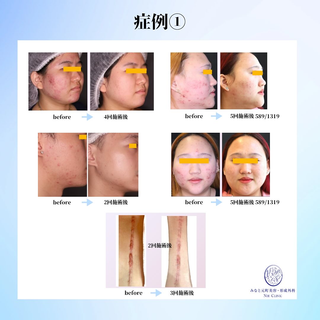 アドバテックスレーザー導入前のお知らせ