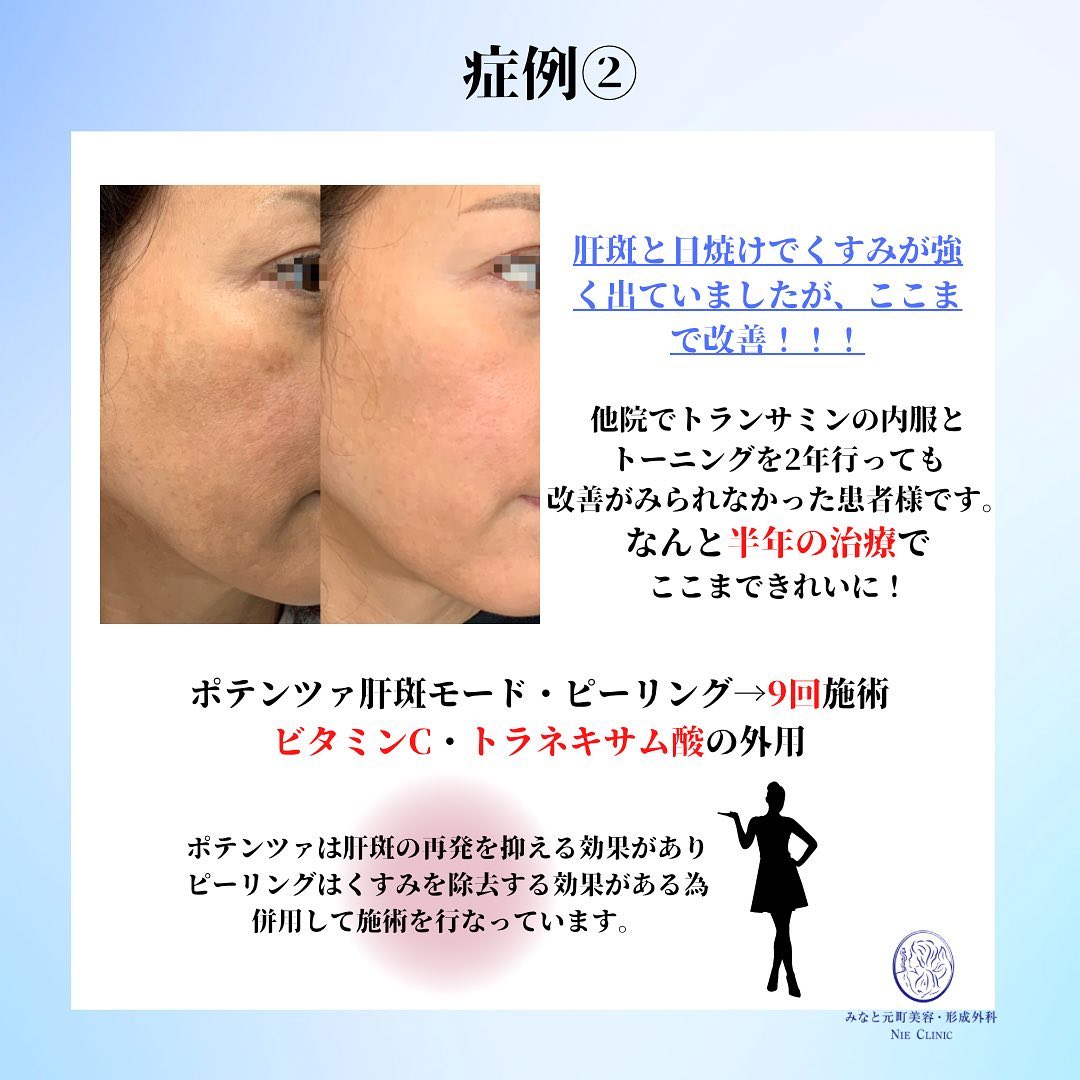 お肌の救世主・ポテンツァ