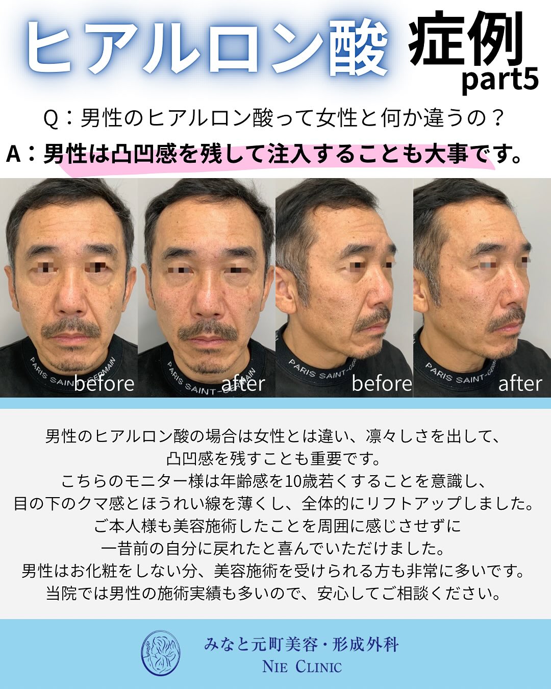 ヒアルロン酸施術のご紹介