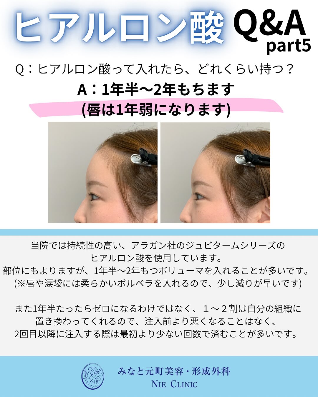 ヒアルロン酸のよくある質問
